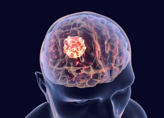 Avance contra el cáncer de cerebro: los campos eléctricos impulsan el éxito de la inmunoterapia