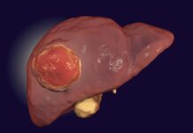 Низькобілкові дієти можуть сповільнити прогресування раку печінки, передбачає дослідження.