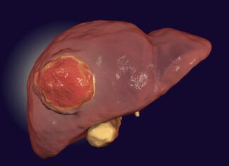 Низькобілкові дієти можуть сповільнити прогресування раку печінки, передбачає дослідження.