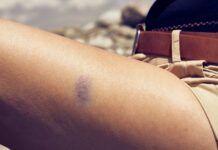 Почему частые необъяснимые синяки могут быть связаны с СДВГ