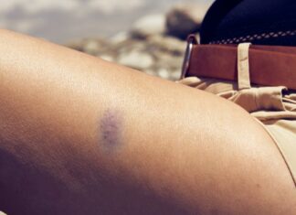 Почему частые необъяснимые синяки могут быть связаны с СДВГ